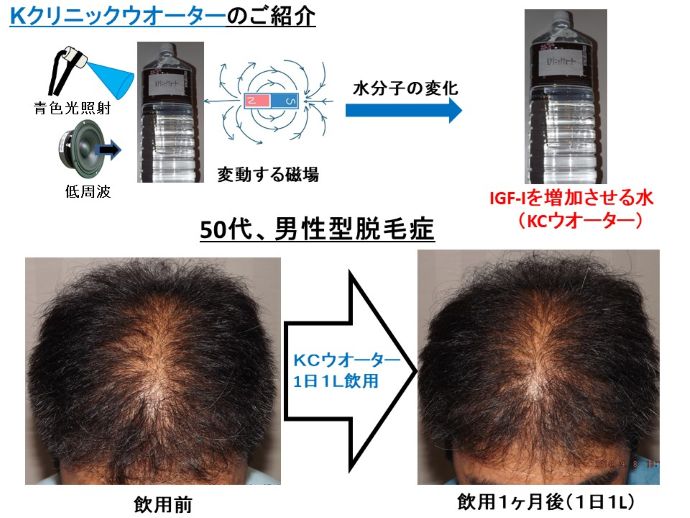円形脱毛症　病院
